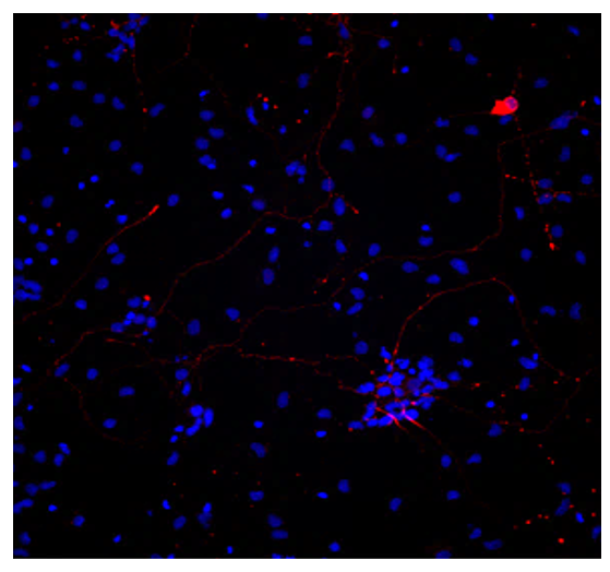 Neurones malades Parkinson